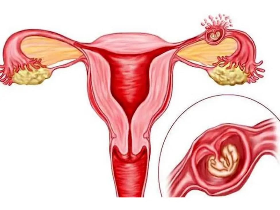 علائم بارداری خارج از رحم چیست؟ علت و درمان حاملگی خارج رحمی
