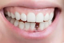 حساسیت به ایمپلنت تیتانیوم + دلایل و راه تشخیص