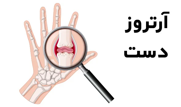 علائم آرتروز دست چپ چیست؟