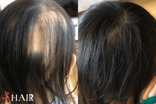 اسکراب اسکالپ سر، سکوی پرتاب بسوی درآمد میلیاردی