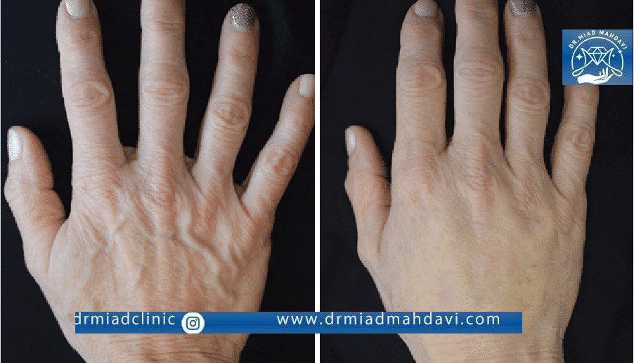 نتیجه تزریق فیلر بدن