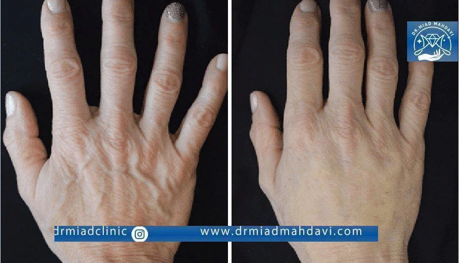 نتیجه تزریق فیلر بدن